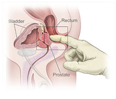 Prostate Milking-Learn How