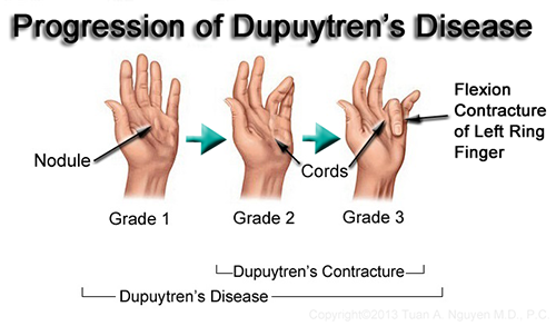 Dupuytren's Contracture-image-result-picture-dupuytrens-contractur-png
