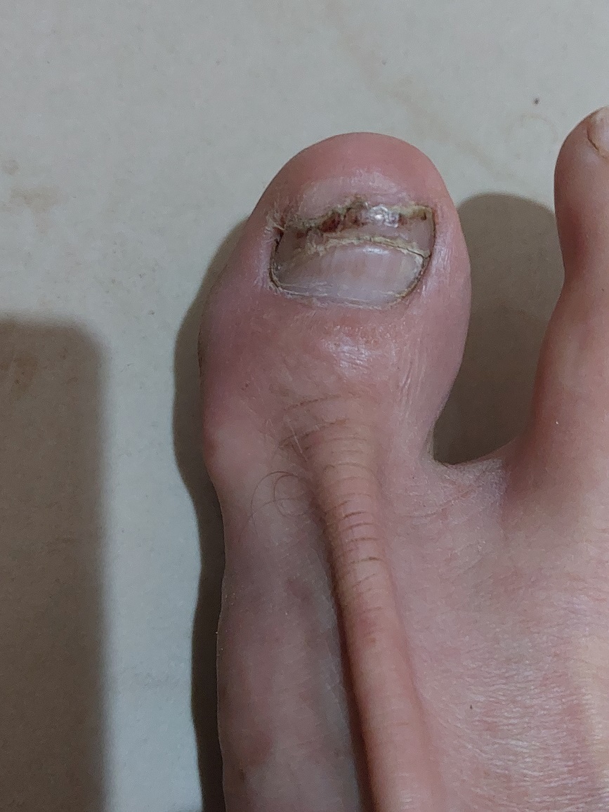 Show us yer toes - WARNING GRAPHIC-20220121_094639-jpg